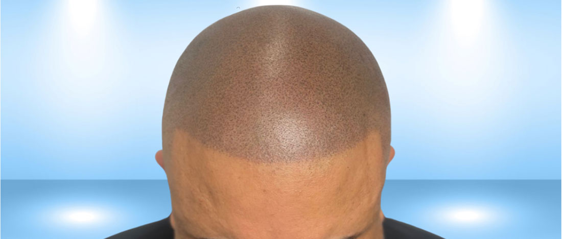 Micropigmentación Capilar: