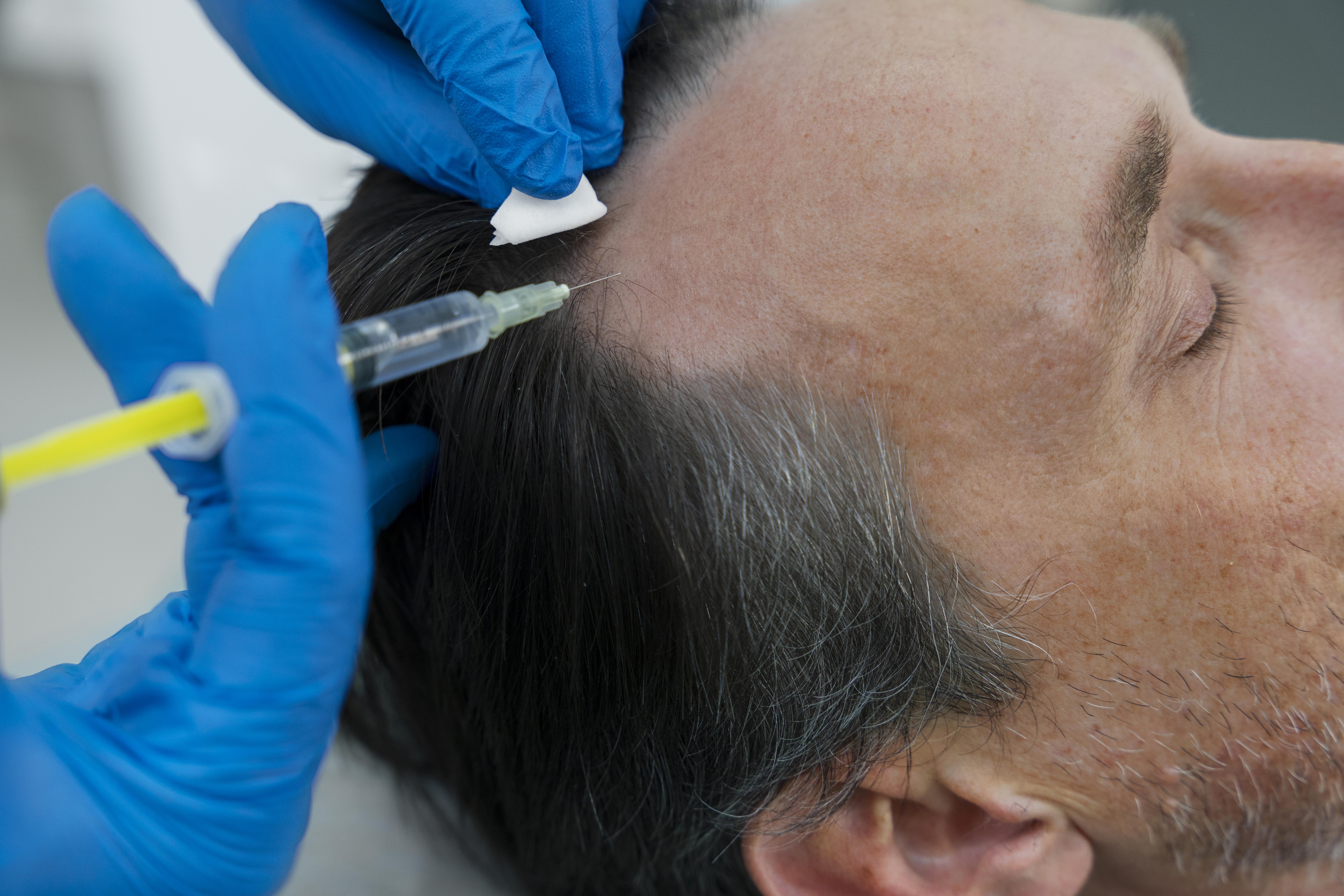 hombre-recibiendo-tratamiento-caida-cabello perdidacabello