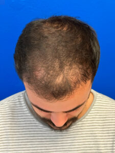Resultados de la cirugia de cabello