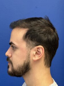 Mayor naturalidad con la cirugia de cabello
