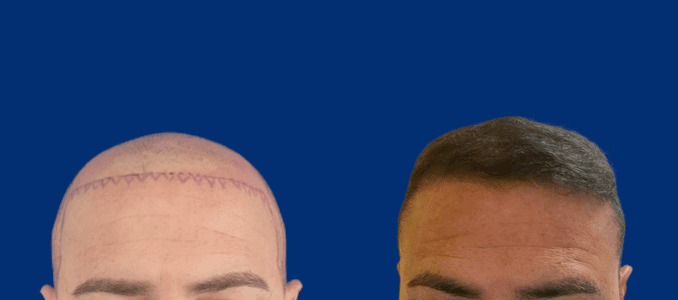 Cirugia de cabello