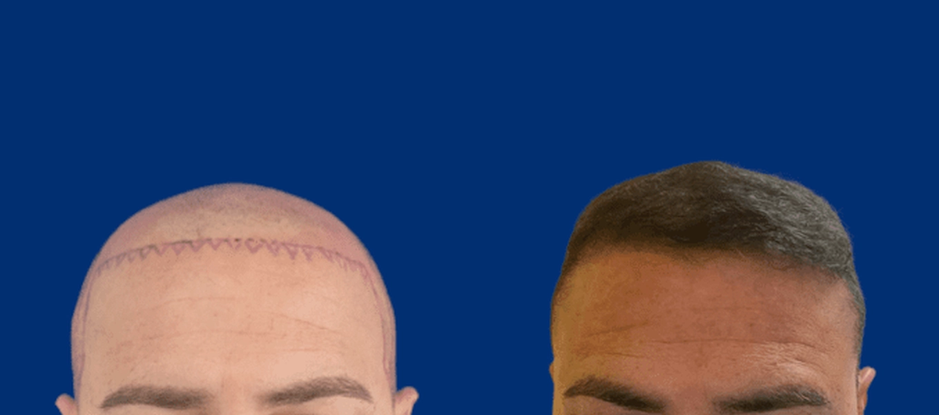 Cirugia de cabello