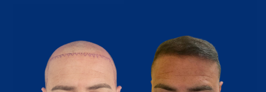 Antes y después de un trasplante capilar DHI