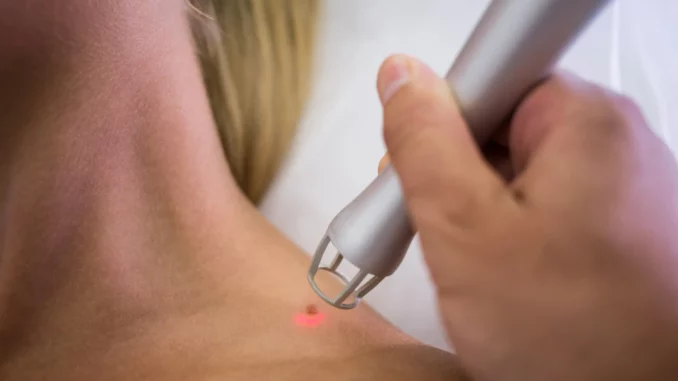 dermatologo-que-quita-lunar-hombro-mujer