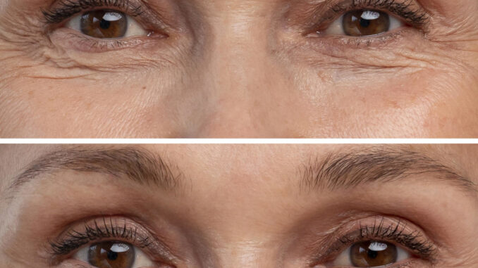 beneficios del prp facial