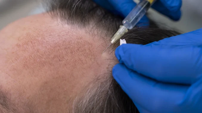 mesoterapia capilar