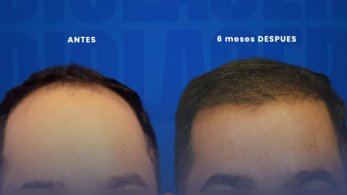 DIOLASER