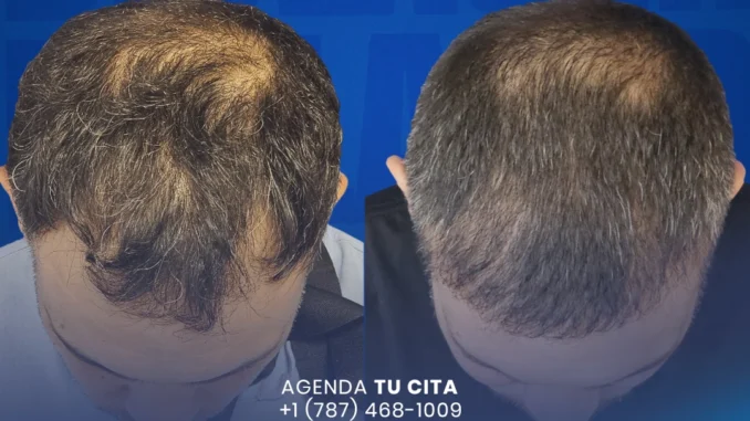 DIOLASER-trasplante de pelo