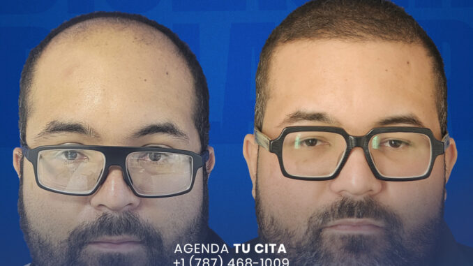 DIOLASER-injertodepelo