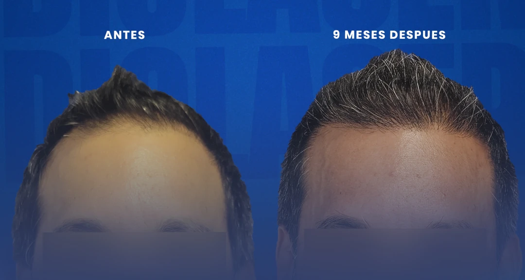 Máxima los Resultados de tu Trasplante Capilar.