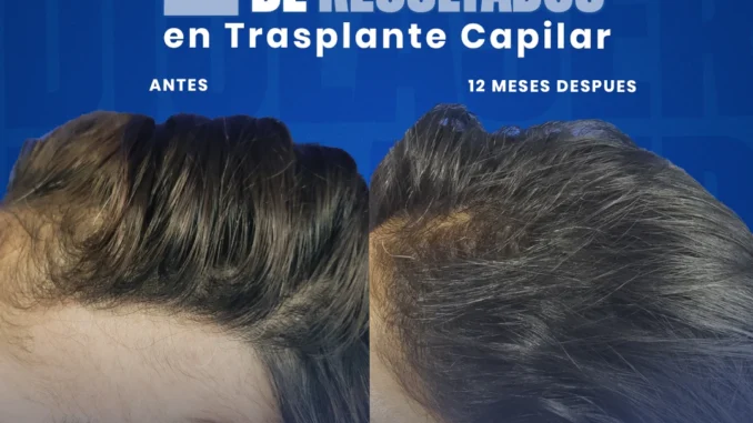 alopeciaareata2decadasderesultados
