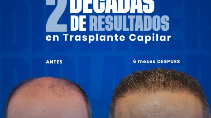 injertodepeloenpuertorico