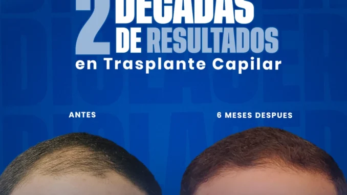 2decadasderesultadoseninjertodepelo