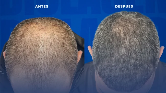 resultadosdeinjertodepelo
