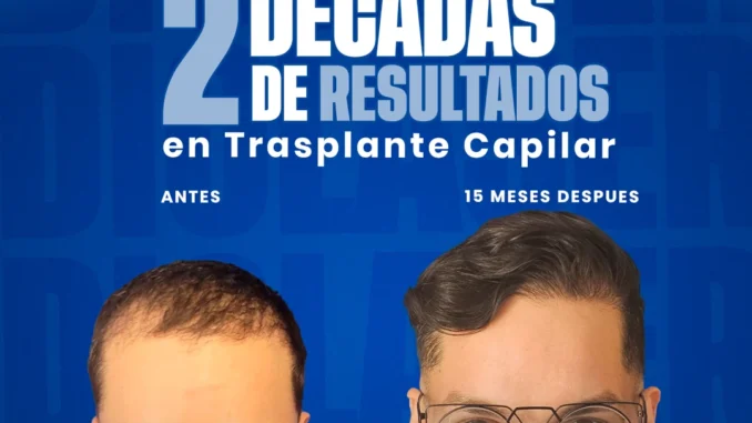 2decadasderesultadoseninjertodecabello