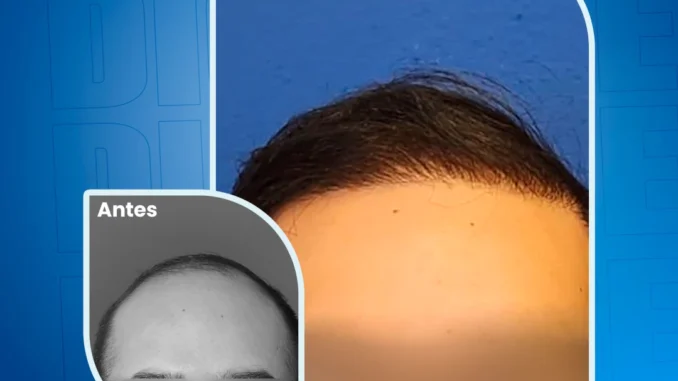 9mesesdelinjertodepelo