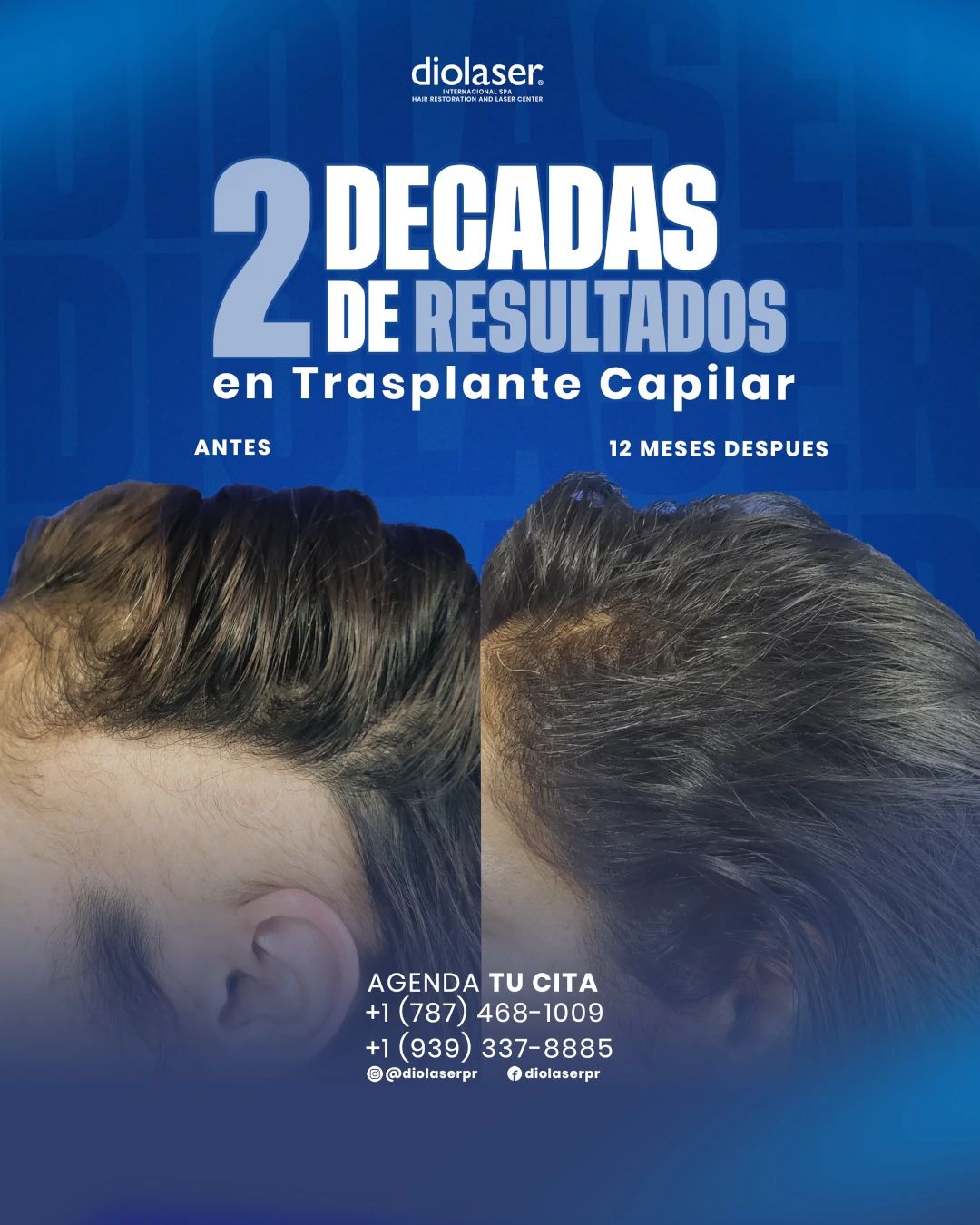 Resultados 12 meses despues del Trasplante capilar.