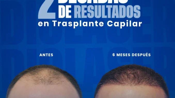 injertodepelo2025