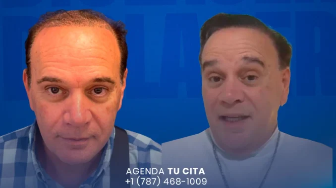 1anodespuesdelinjertodepelo-1