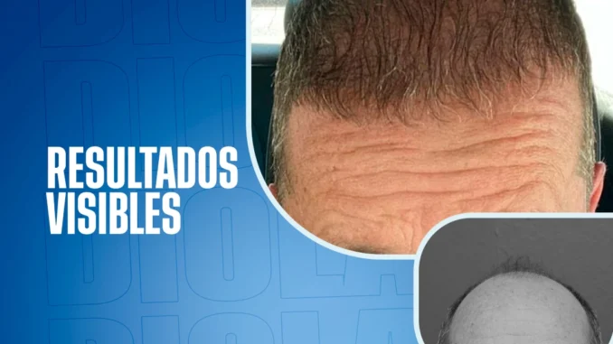 6mesesdespuesdelinjertodepelo