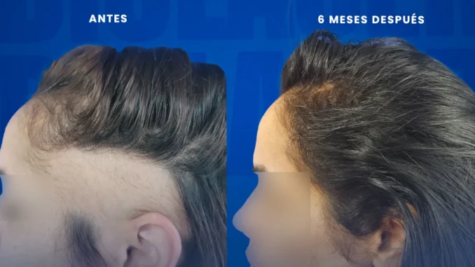 alopeciaareata