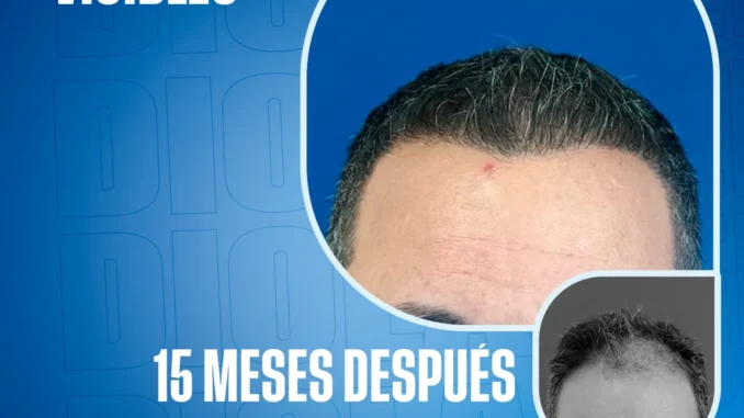 injertodepelo15mesesdespuesendiolaser