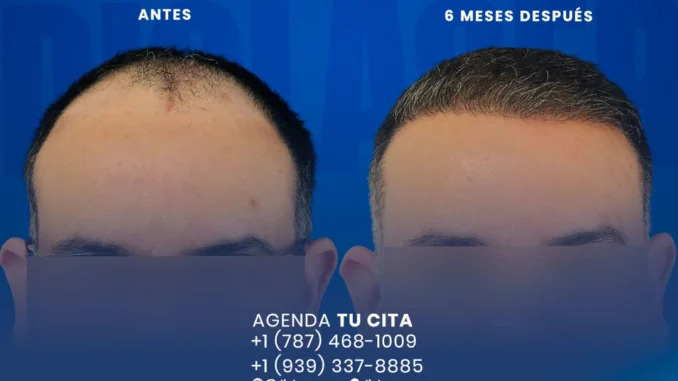 resultadosdiolaserpuertorico