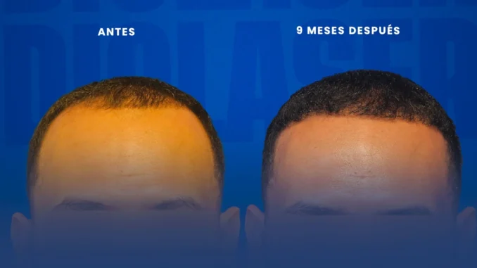 injertodecabelloendiolaser