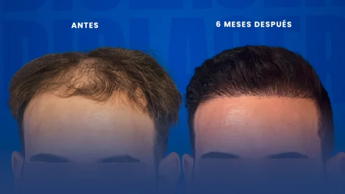 resultdosendiolaser