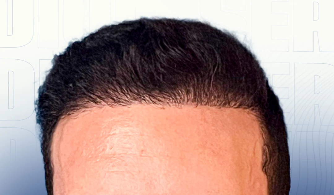 ¿Sabías que la naturalidad del trasplante capilar depende de varios factores?