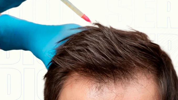 mesoterapiacapilardediolaser