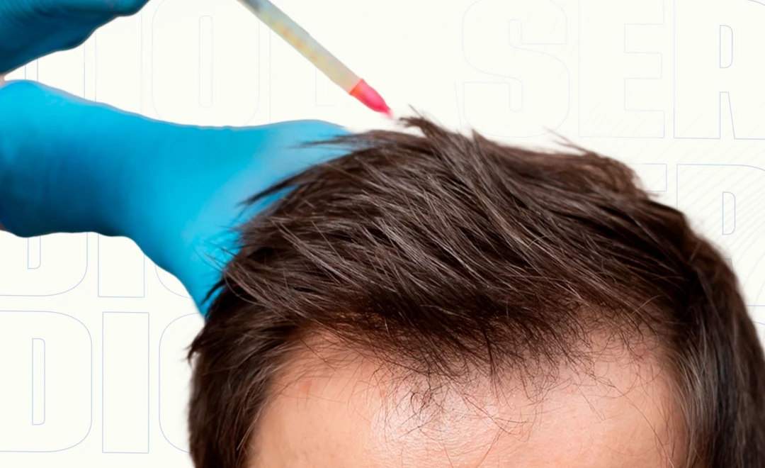 ¿La mesoterapia funciona en la etapa temprana de la alopecia?.