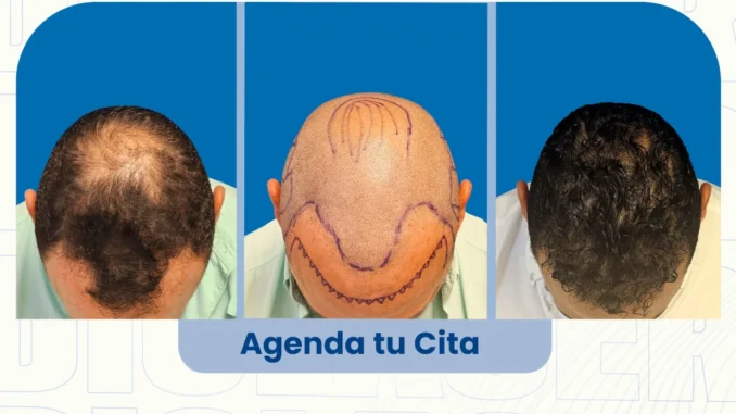 resultadosdetrasplantedecabello